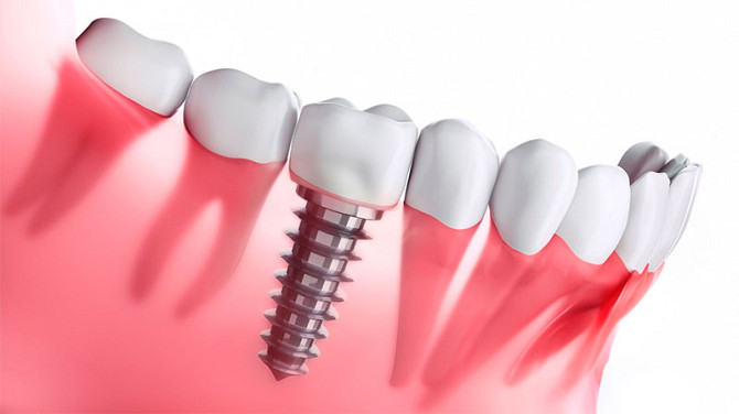 Высококачественная установка современных зубных имплантов в Черкассах Черкассы - изображение 1