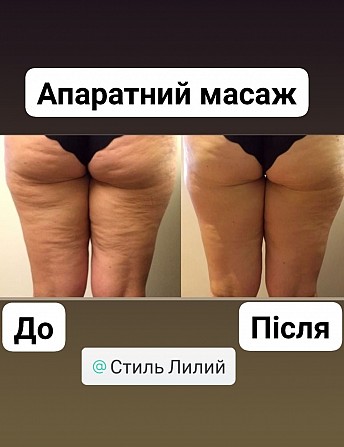 Антицелюлітний масаж (апаратний) Нежин - изображение 1