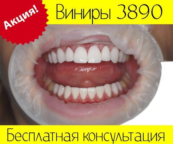 Виниры Киев 3890 грн. по Акции Київ - изображение 1