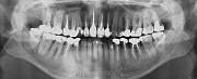 Панорамний знімок зубів (ортопантомограмма) Миргород
