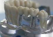 Имплантация и удаление зубов всех видов сложности Бровары