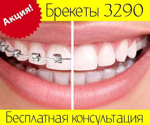 Установка брекетов в Киеве 3290 грн. по акции Київ - изображение 1