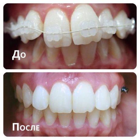 Установка брекетов в Одессе по акции Одесса - изображение 1