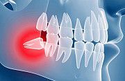 Срочное удаление зубов мудрости в Черкассах Черкассы
