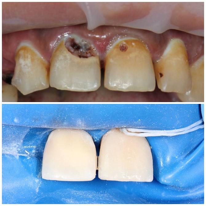 Реставрація зубів Хмельницкий - изображение 1